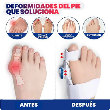 Correctores de Juanete Ajustable - Alivio Ortopédico